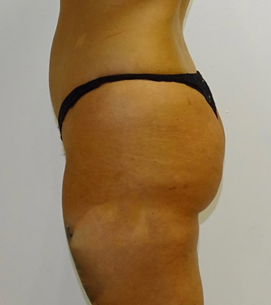 Brazilian Bum Lift surgery UK after photo 15