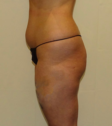 Brazilian Bum Lift surgery UK before photo 15