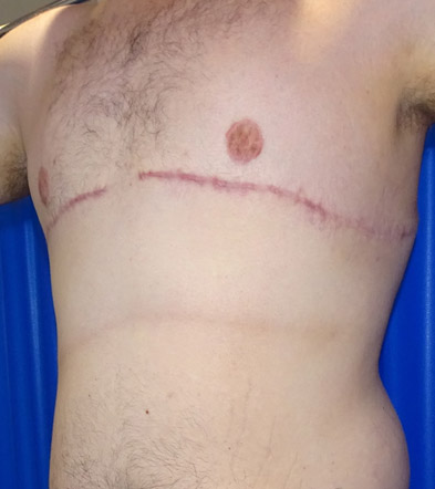 Gynaecomastia Treatment Example 2021 1 After