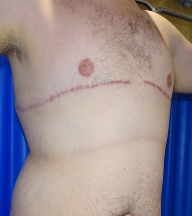 Gynaecomastia Treatment Example 2021 2 After