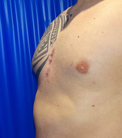 Pectoral Implant Example 3 After