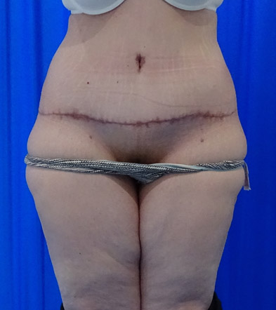 Tummy Tuck London Example 5 After