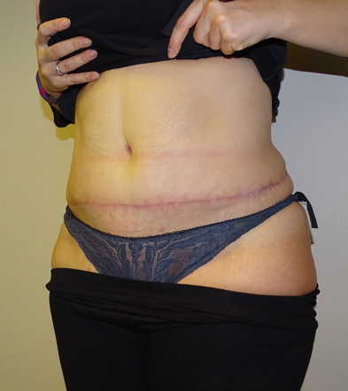 Tummy Tuck UK Example 5 After
