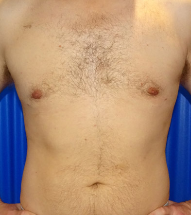 Gynaecomastia Treatment Example 1 After