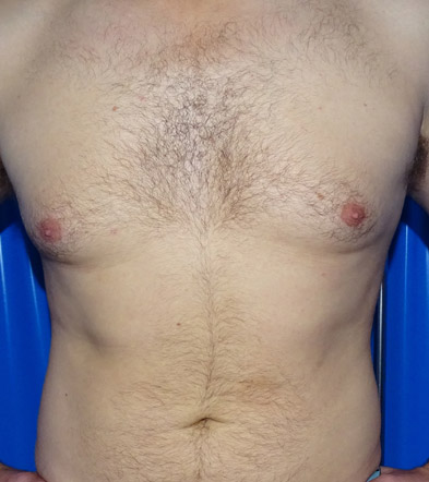 Gynaecomastia Treatment Example 1 Before