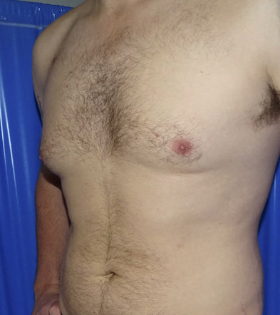 Gynaecomastia Treatment Example 2 Before