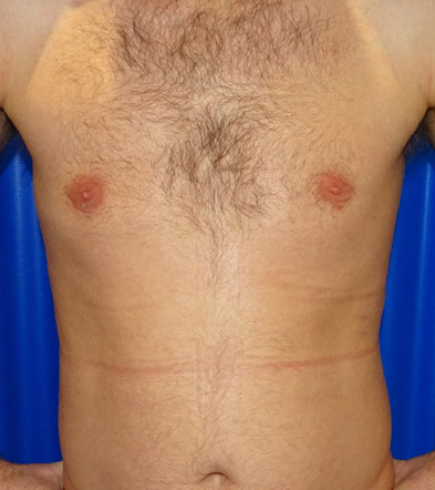 Gynaecomastia Treatment Example 3 After