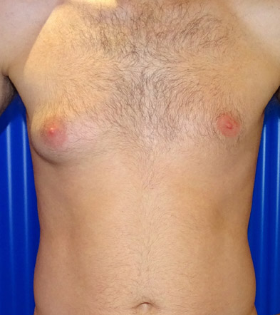 Gynaecomastia Treatment Example 3 Before