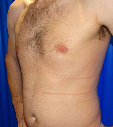 Gynaecomastia Treatment Example 4 After