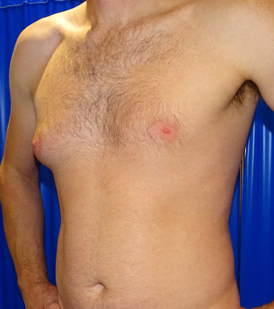 Gynaecomastia Treatment Example 4 before