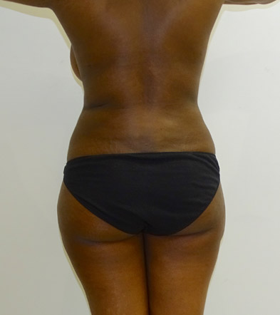 Liposuction example 1 after