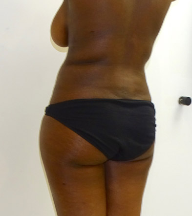 Liposuction example 2 after