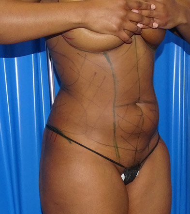 Liposuction example 3 before