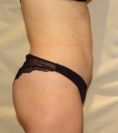 Liposuction example 4 after