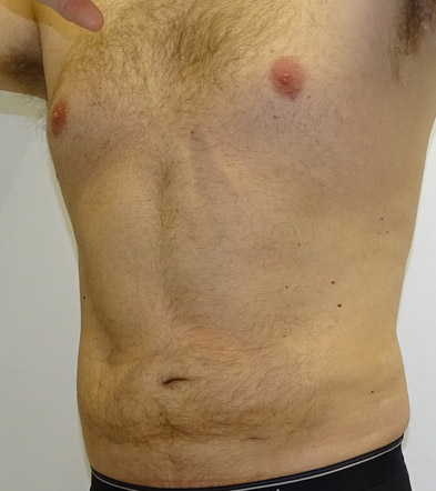 Liposuction example 5 after