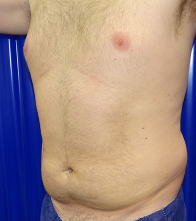 Liposuction example 5 before
