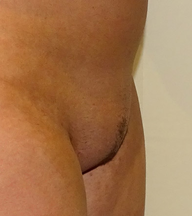 Liposuction example 6 before