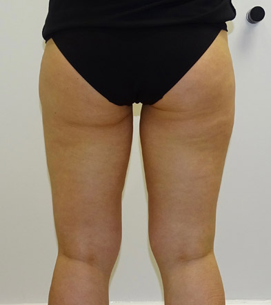 Liposuction example 7 after
