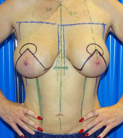 Mastopexy Example 3 Before