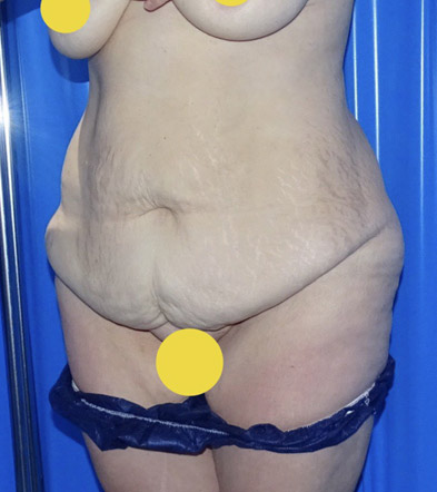 Tummy Tuck London Example 10 Before