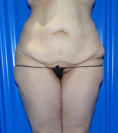 Tummy Tuck London Example 5 Before