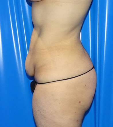 Tummy Tuck London Example 7 Before