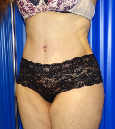 Tummy Tuck UK Example 2021 1 After