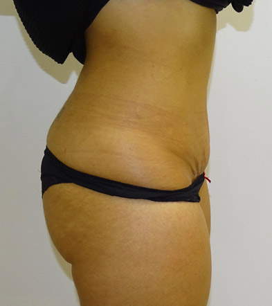 Tummy Tuck UK Example 4 2021 After