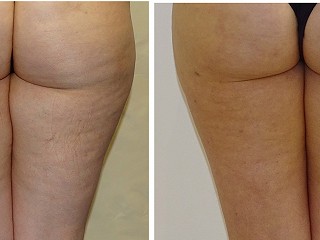New Treatment for Cellulite