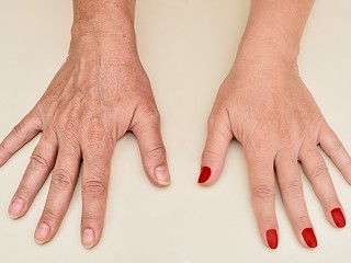 Hand Rejuvenation. Why and how
