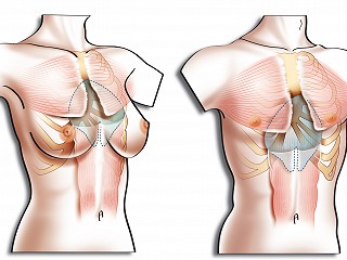 New Technologies Allow Superior Custom-made Silicone Implants